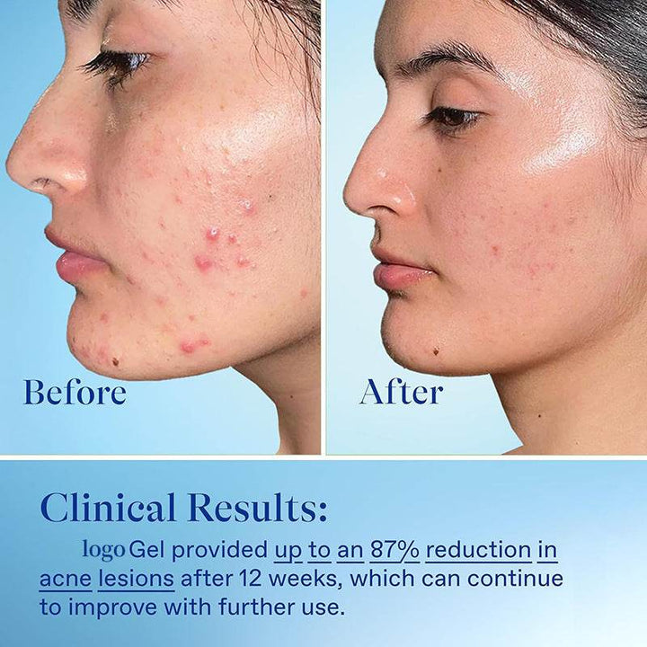 Freckle Removing Treat Acne Gel - ZEYTONCART